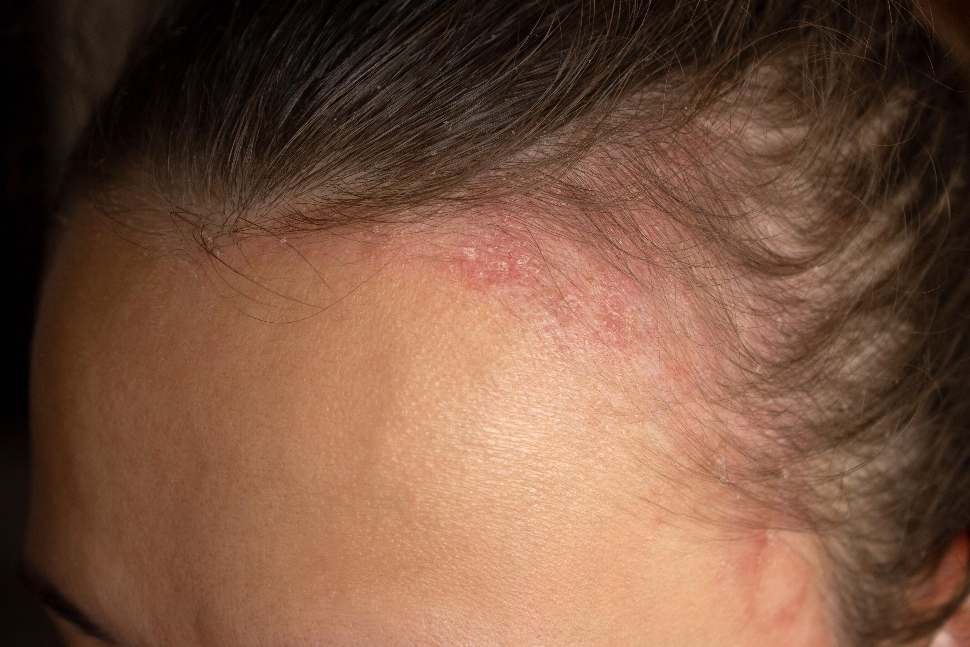 Seborrheic dermatitis of the forehead